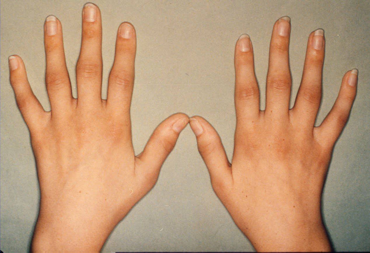 Artrita reumatoida: 5 tipuri de exercitii pentru maini